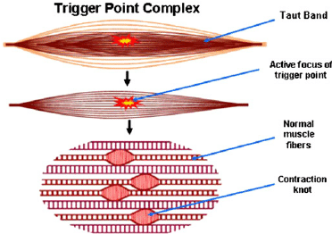 Trigger Point Complex