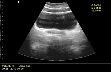 EMG biofeedback and Ultrasound for pelvic floor